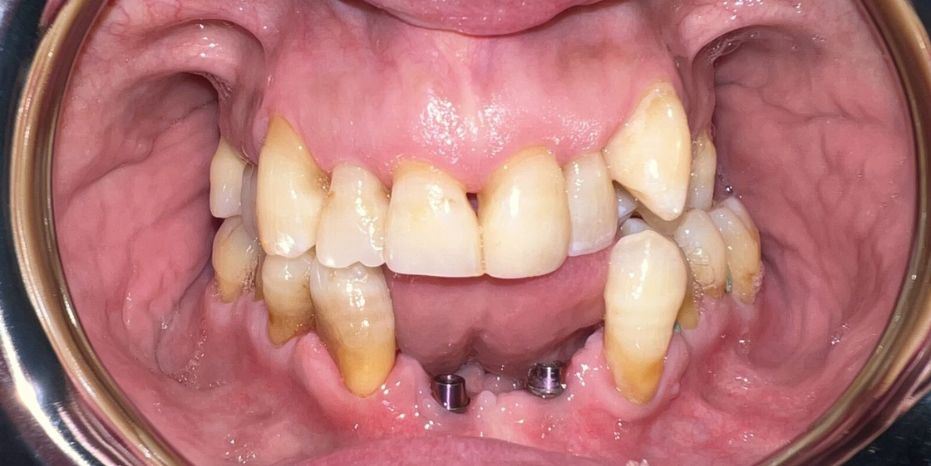 IMPLANTES DENTALES  